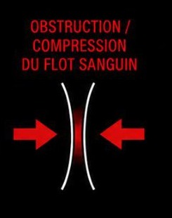 Obstruction et compression du flot sanguin : le vaisseau est écrasé par la contraction